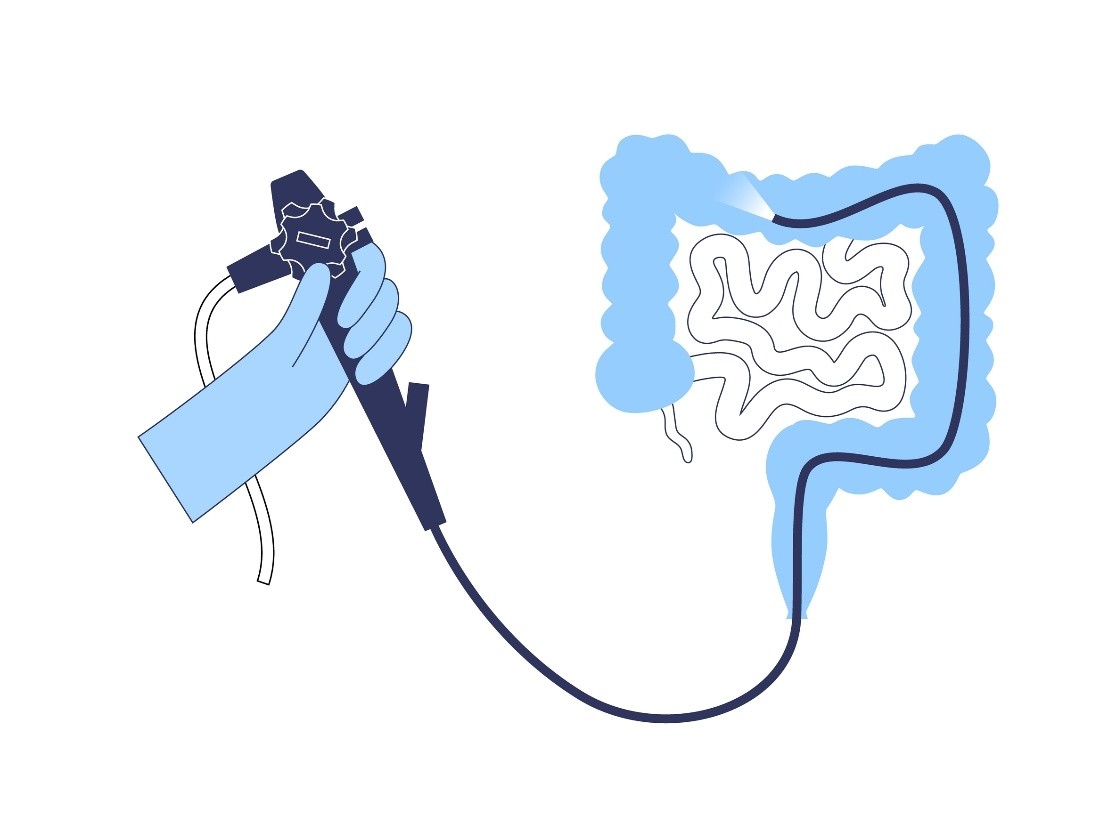 Illustration of colonoscopy procedure