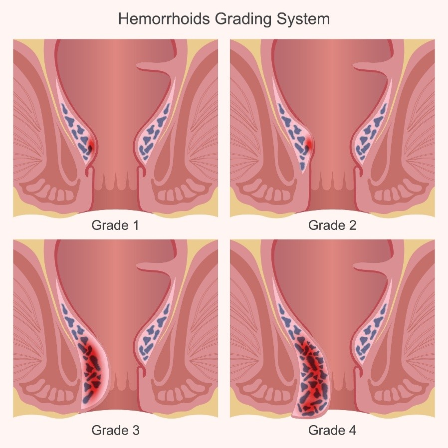 Grades of haemorrhoids/piles