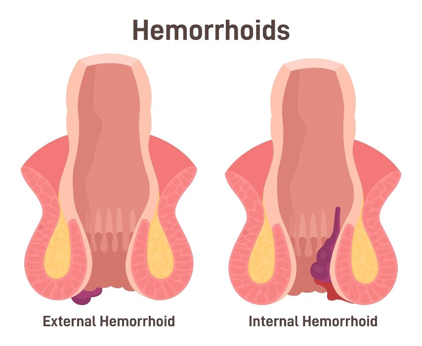 Internal and external haemorrhoids diagram